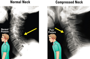 Eliminate Neck Stiffness | The Pain & Injury Doctor